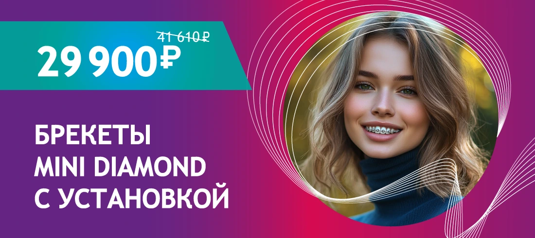Брекеты Mini Diamond с установкой за 29 900 ₽